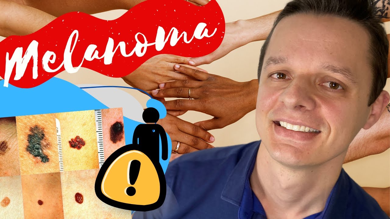 МЕЛАНОМА: 5 признаков, которые могут спасти вам жизнь !!!