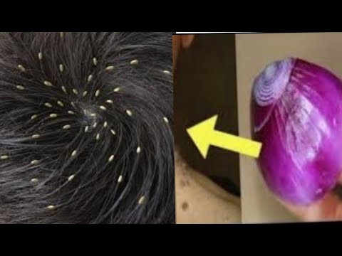 How To Get Rid Of Head Lice Naturally At Home| The Safest Way To Get Rid Of Lice In 2 Days - YouTube