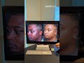 تجميل الاذن البارزة مع الدكتور بشار بزرة | افضل واشهر جراح تجميل اذن في دبي ولندن | مركز بزرة ميد