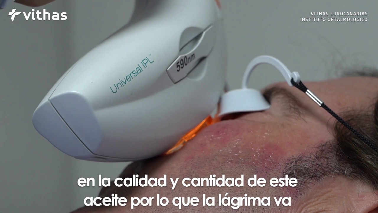 ¿Por qué es tan eficaz el tratamiento con luz pulsada para el ojo seco