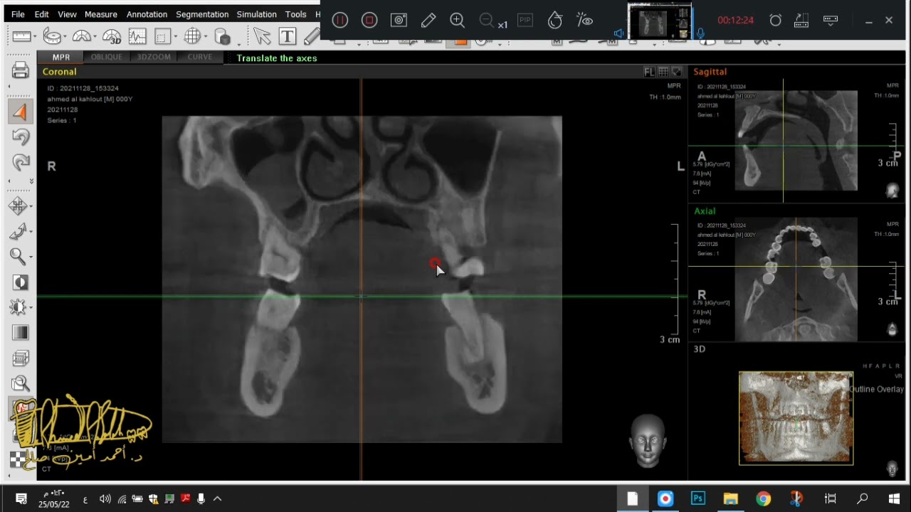 محاضرة وشرح مبسط لكيفية استخدام برامج الاشعة ثلاثية الابعاد CBCT