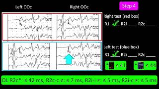 Blink Reflex Test. Practice 1