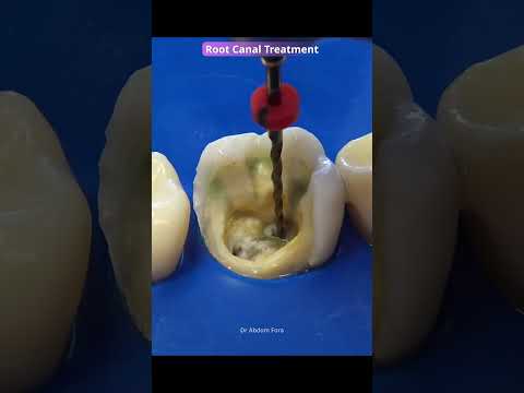 Root canal video