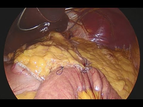 Mini gastric bypass UNCUT - January 2018 - Doç. Dr. Recep Aktimur