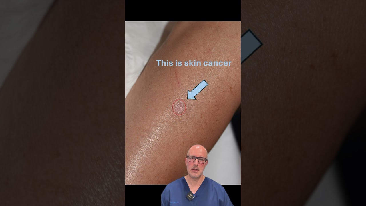 Skin Cancer vs Eczema, Psoriasis & Scars | How to Tell the Difference