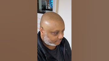 Beware of choosing the right Scalp Micropigmentation provider