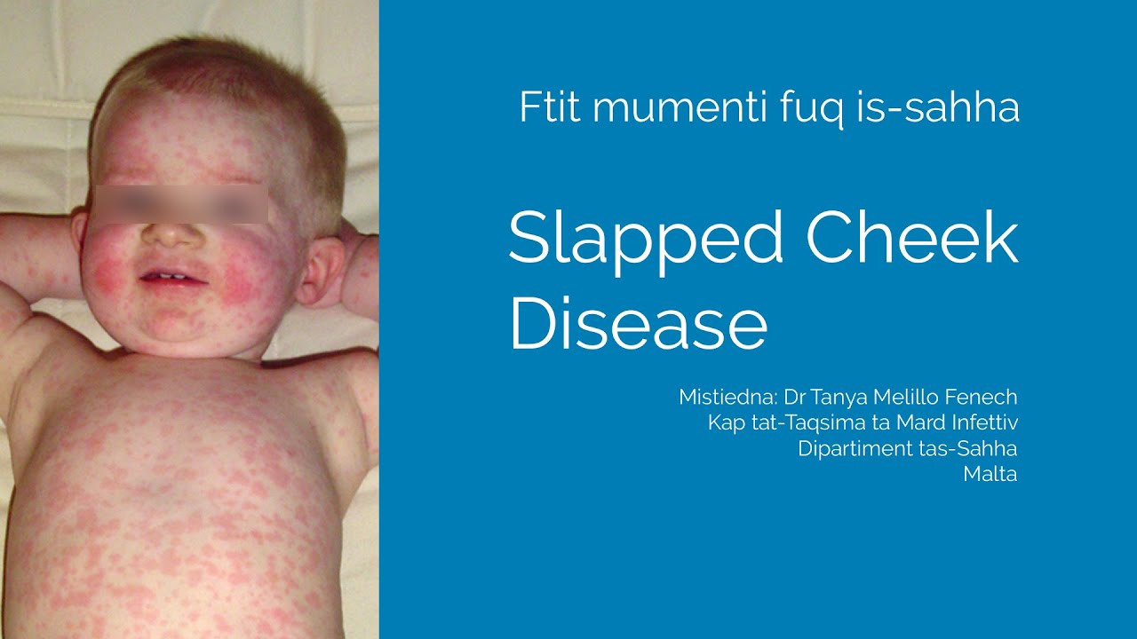 Ftit Mumenti duq is Sahha    Slapped Cheek Disease