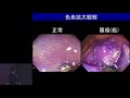 大腸がんの内視鏡診断・治療、最前線！　福田  将義
