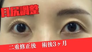 切開で二重修正後の目頭側のゆるみを調整しました　完成