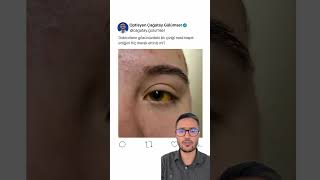 Gözünüzde Bir Çizik Olursa Nasıl Tespit Edilir