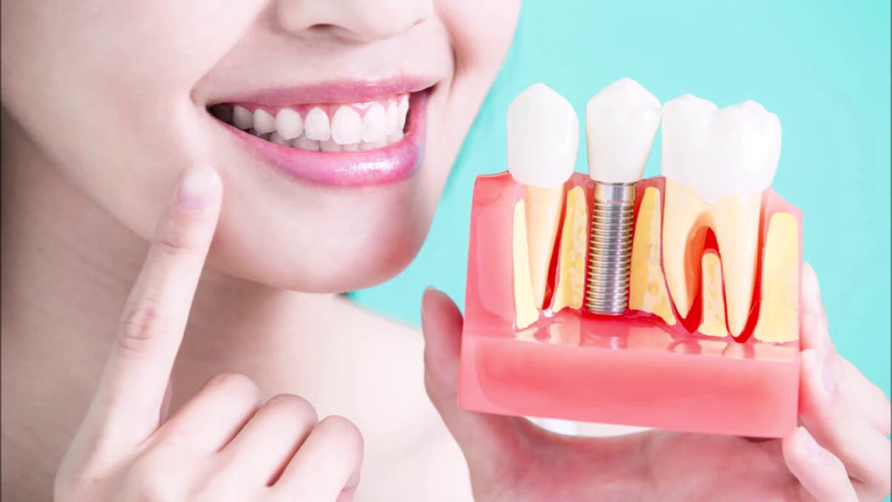 Dental Implant Services with Latest Advanced Technology in Rohini