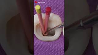 Tooth Filling ! Root Canal Treatment
