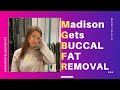 Patient experience how to lose face fat buccal fat removal