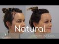 Female Hair Transplant FUT, Hairline Lowering-2150 Grafts-Maitland Clinic-Dr. Ball