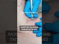Лазерное удаление папиллом на шее