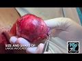 AVOCADO CYST. Gigantic cyst removal size of large avocado. Cyst popped on surgery tray. Excision.