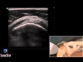 Dmo 3d chographie du tendon du suprapineux  chographe sonosite