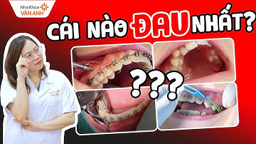 Niềng Răng Đau Nhất Khi Nào? 5 Giai Đoạn Gây Khó Chịu Nhất Khi Niềng