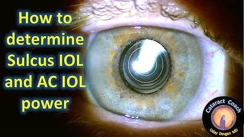sulcus IOL placement in complicated cataract surgery