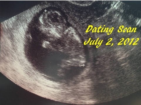 12 WEEK PREGNANCY SCAN AND SCREENING from YouTube · Duration: 4 minutes 27 seconds 12 WEEK PREGNANCY SCAN AND SCREENING from YouTube · Duration: 4 minutes 27 seconds