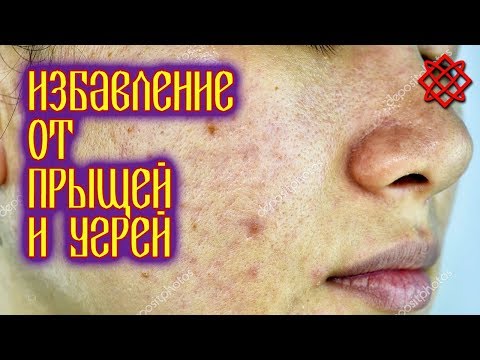 Video: Odakle dolaze acne vulgaris?