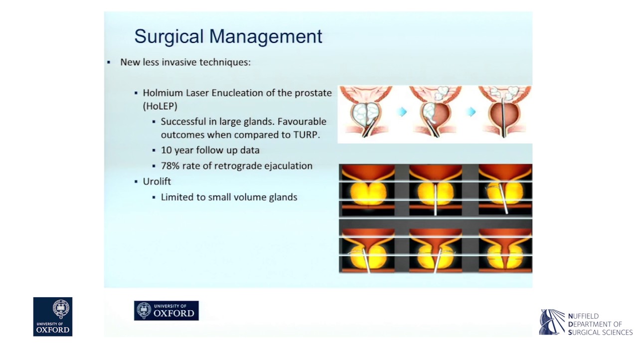 Oxford University surgical lectures: prostate artery embolisation in ...