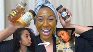 How to get rid of dark spots/acne scars OVERNIGHT!