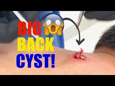 big-back-cyst!