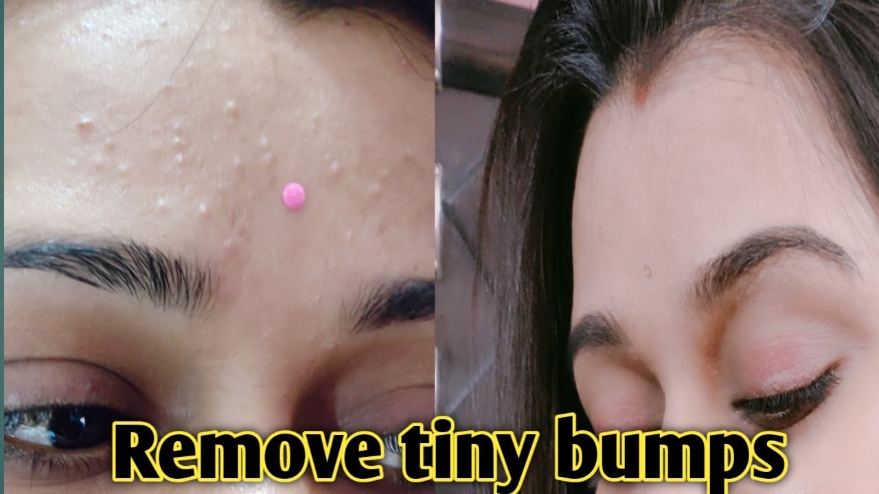 Get Rid Of Tiny Bumps Naturally In 7 Days How To Remove Tiny Bumps