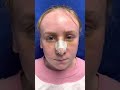 Post op Septorhinoplasty Sinus Surgery Tonsillectomy 4 days ago with minimal bruising