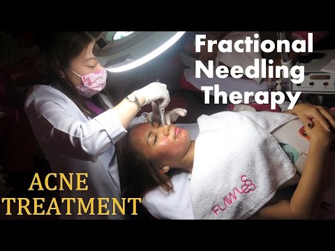 ACNE SCARS Treatment : Fractional Needling Therapy (Review, Demo and Result!!)