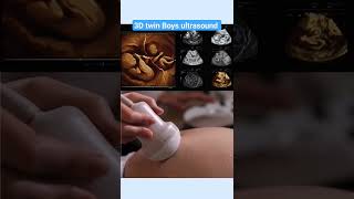 3D ultrasound identical twinsmonochorionic diamniotic twins