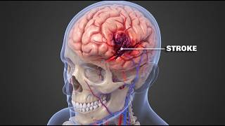 What Happens During a Brain Stroke? Ischemic vs Hemorrhagic Explained in 3D