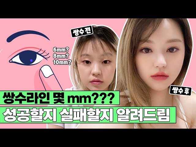 [쌍수] 쌍꺼풀 라인 👁 몇 mm로 해야 성공할까? 🤔