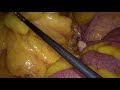 Sigmoid resection for cancer in female BMI 45