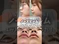 【整形バレなし】切らない鼻整形 | １ヶ月後のリアル♡︎ᵎᵎᵎ