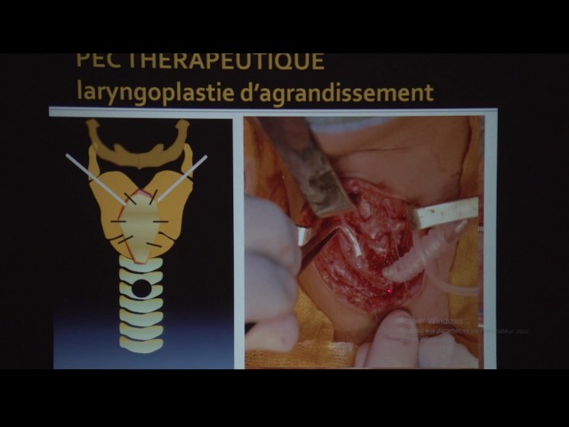 presentateur 5 ________________ smorl 2017 le laser en ORL