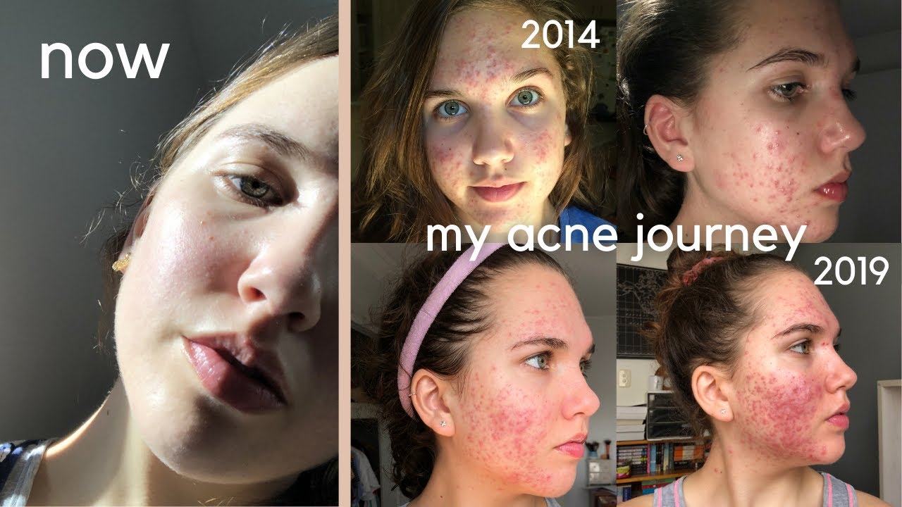 How I Cleared My Acne After 5 Years My Struggle With Acne Youtube