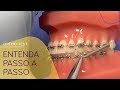 Instalação do Propulsor Mandibular GoToOne da Leone| APM