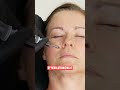 Piriform Fossa Injection Technique