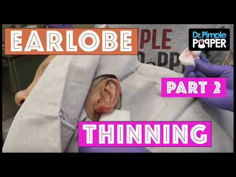 A Patient Looking For A Different Earlobe Found Dr Pimple Popper! Part Two