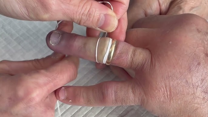 A doctor showed me how to remove the ring that was stuck on my