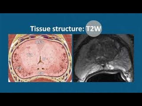 Video: Mērķtiecīgas Prostatas Brahiterapijas Tendences: No Multiparametriskā MRI Līdz Nanomolekulāriem Radiosensitizatoriem