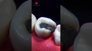 Replacing a Dental Filling #Restoration