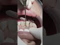 Composite veneer for all anterior teeth after removal of old restoration and deep caries #dentis