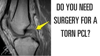 Do you need surgery for a torn PCL?