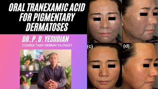 Oral Tranexamic acid for pigmentation