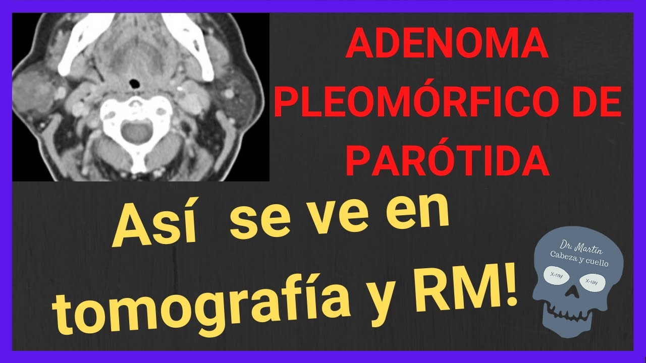 ADENOMA PLEOMÓRFICO de parótida ❇️(en tomografía y RM)