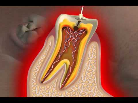 What is Caries?