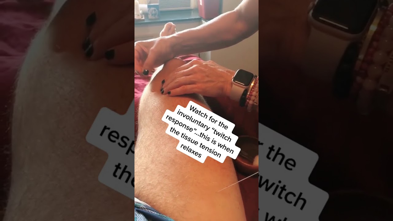 Dr B treating knee pain with Trigger Point Dry Needling (#shorts)